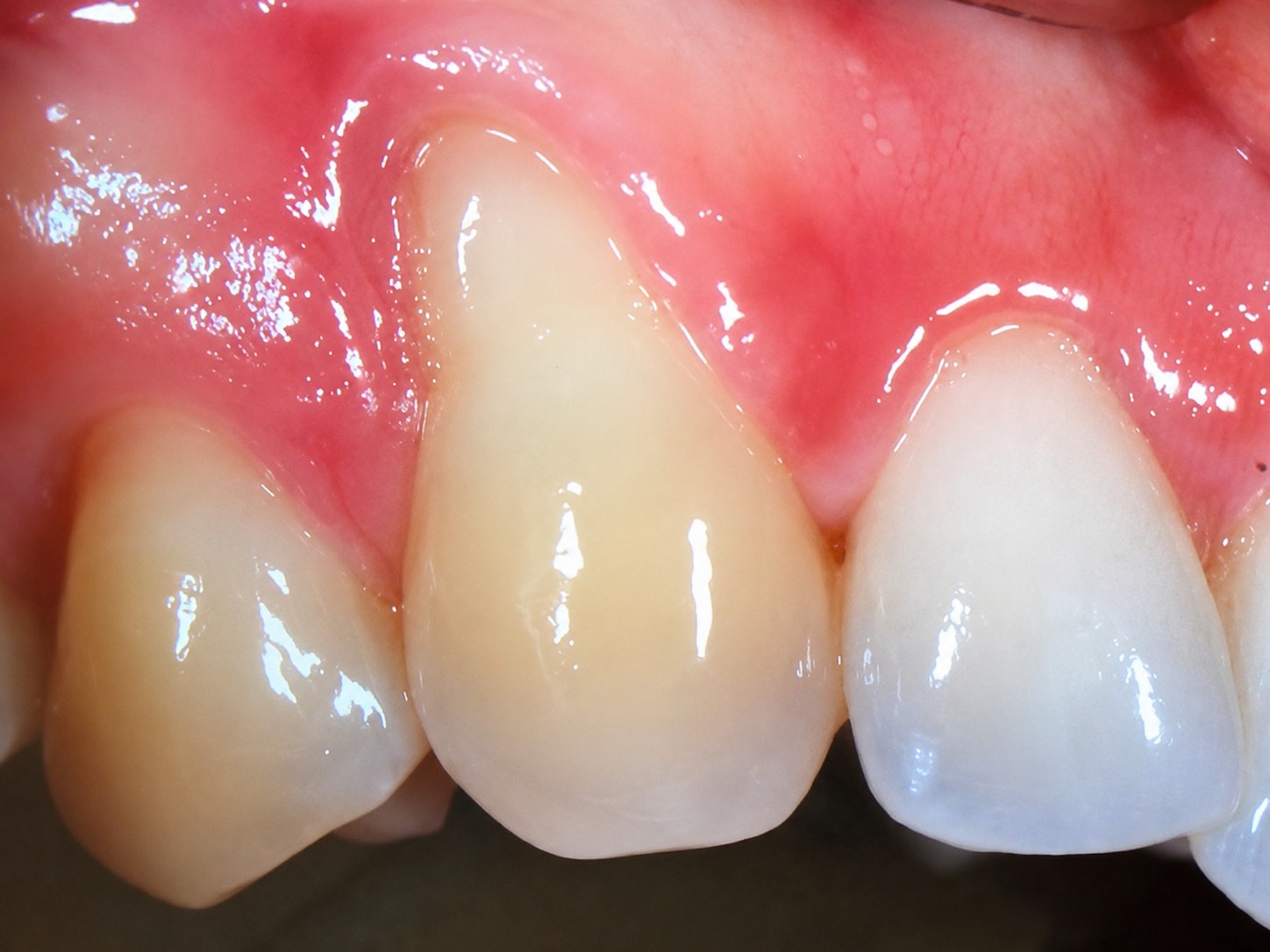 Antes del tratamiento de estética dental