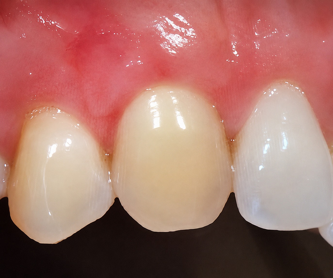 Después del tratamiento de estética dental