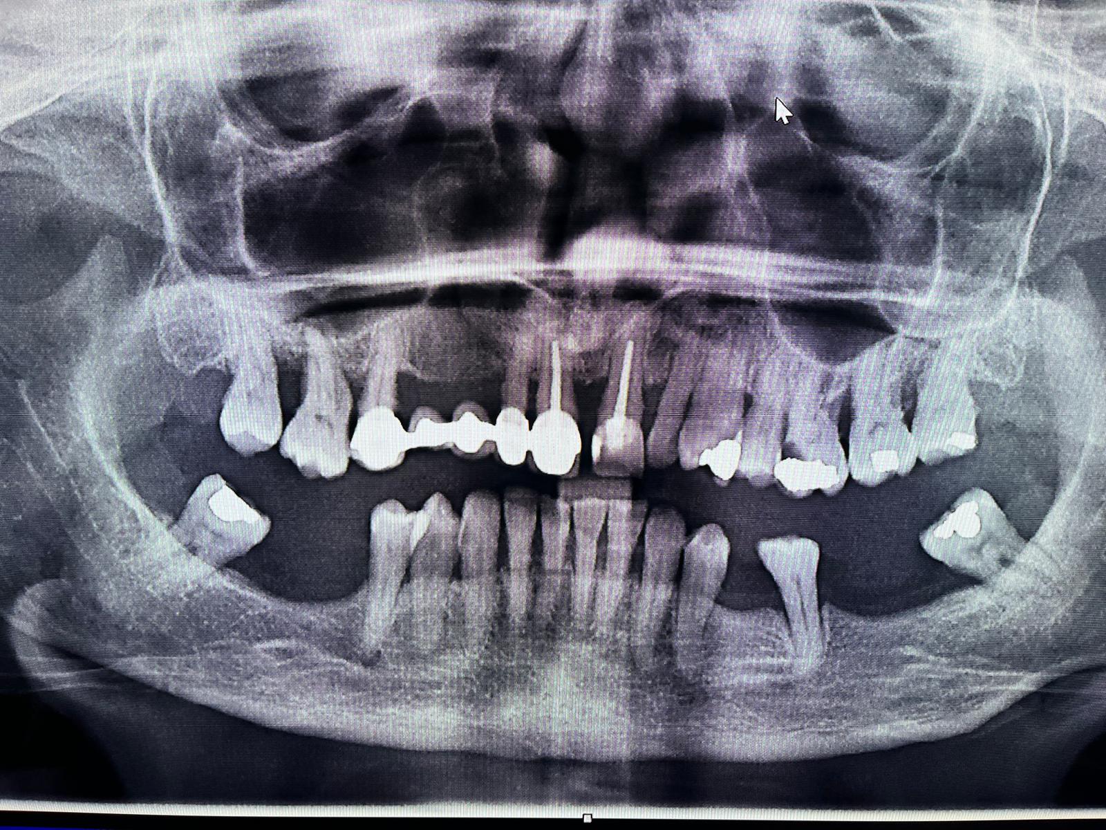 Antes del tratamiento de implantes dentales