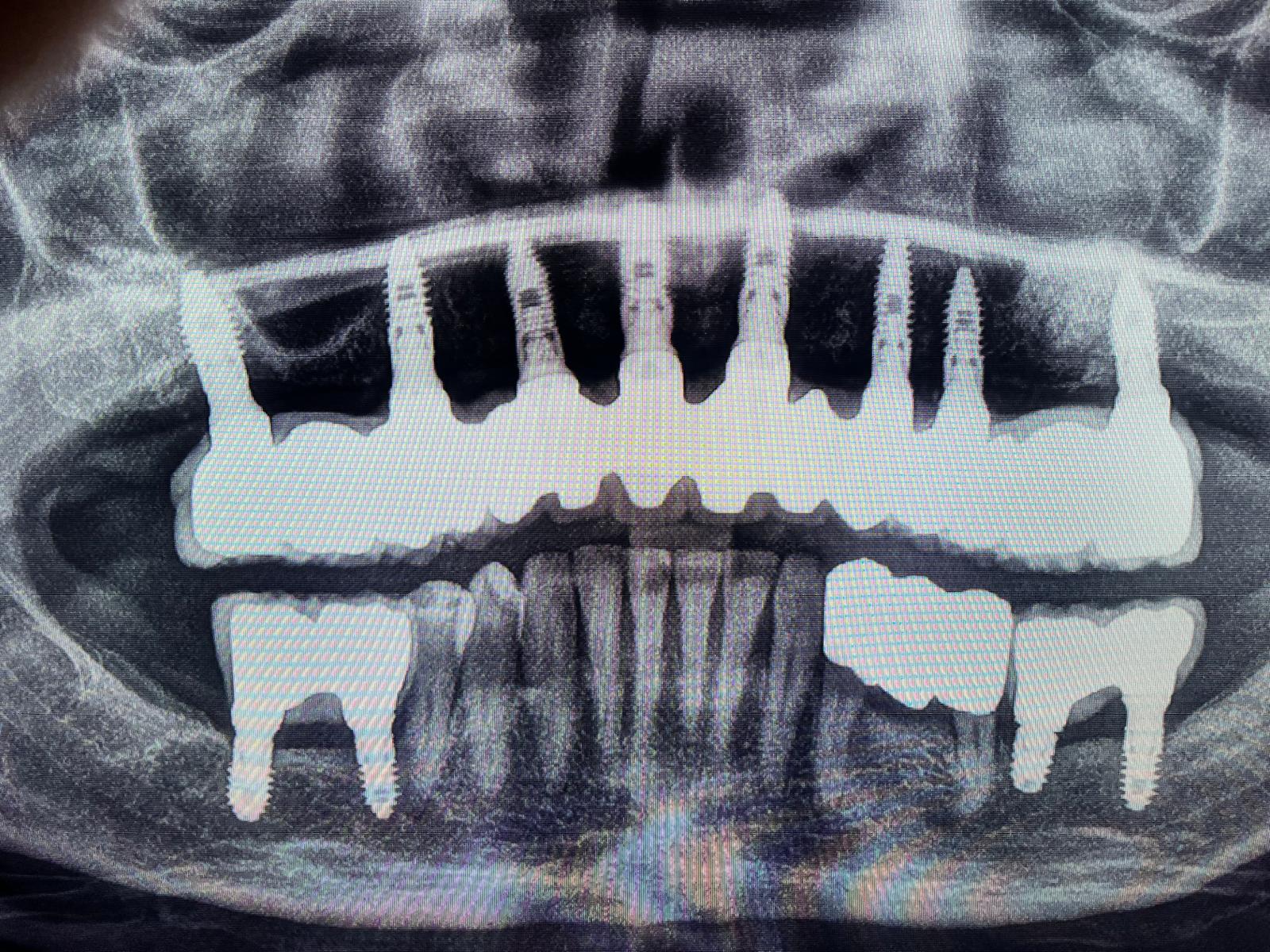Después del tratamiento de implantes dentales
